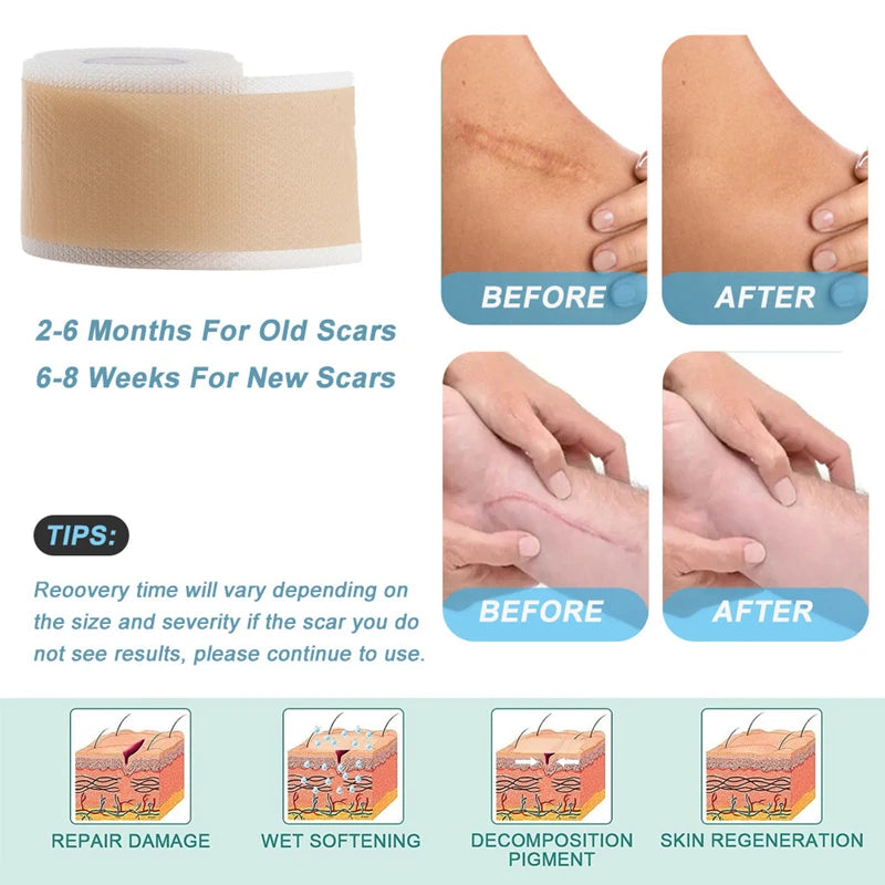 Silicone Gel Scar Patch